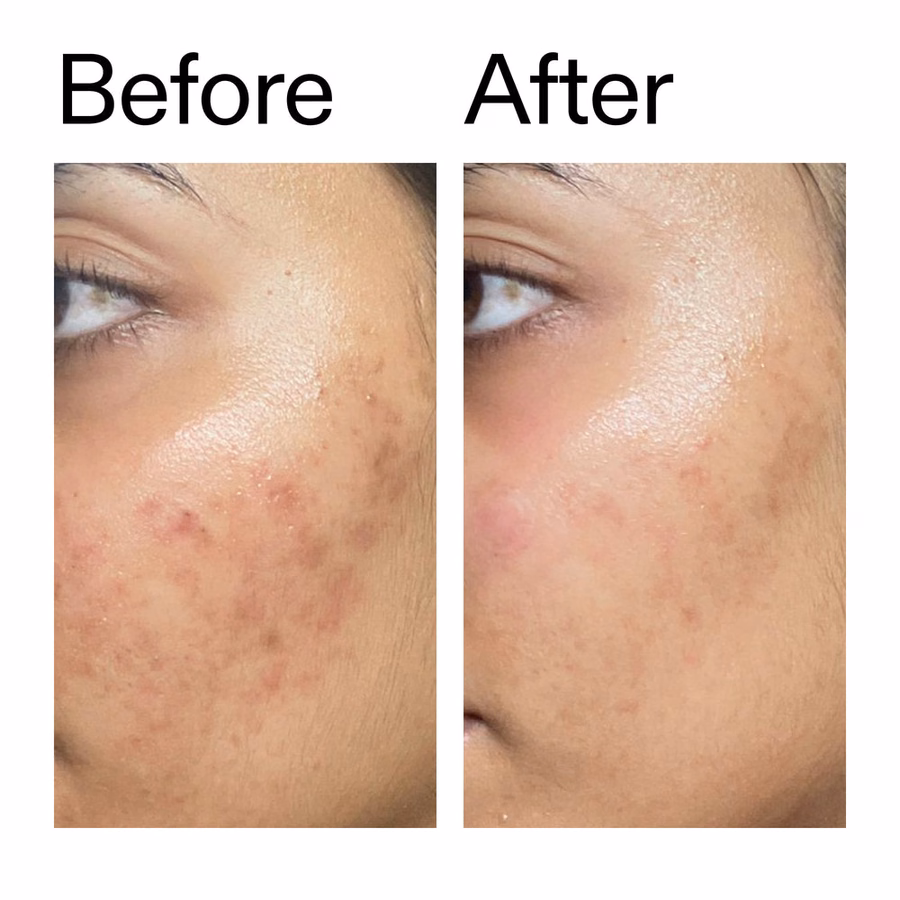 Skin Barrier Serum | 2% Ectoin + Clinical Hydration | INKEY