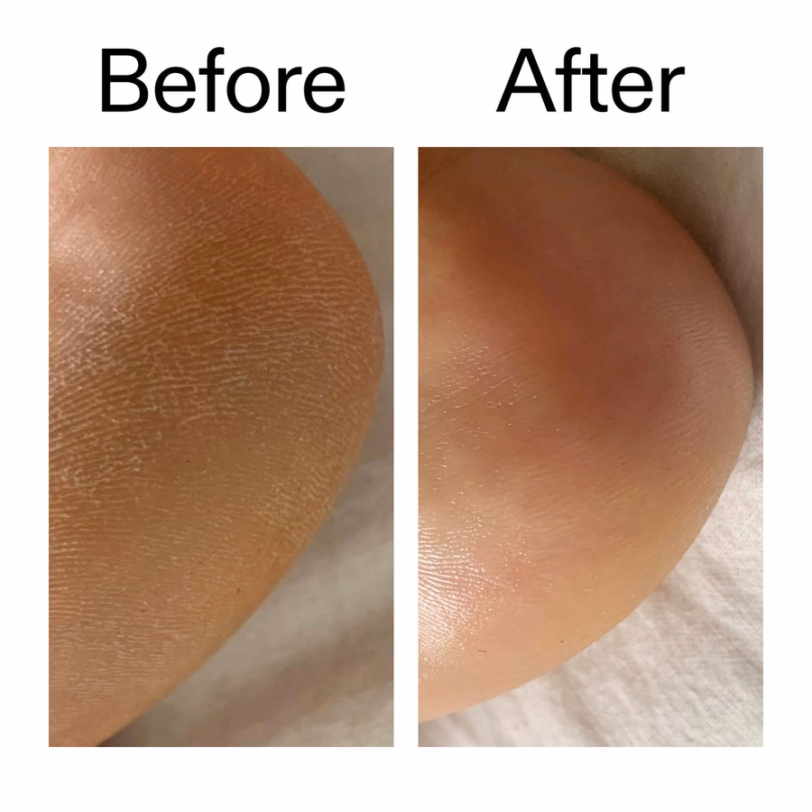 KP Treatment: Glycolic Acid Body Stick for Bumps & Ingrown Hairs | The INKEY List USA