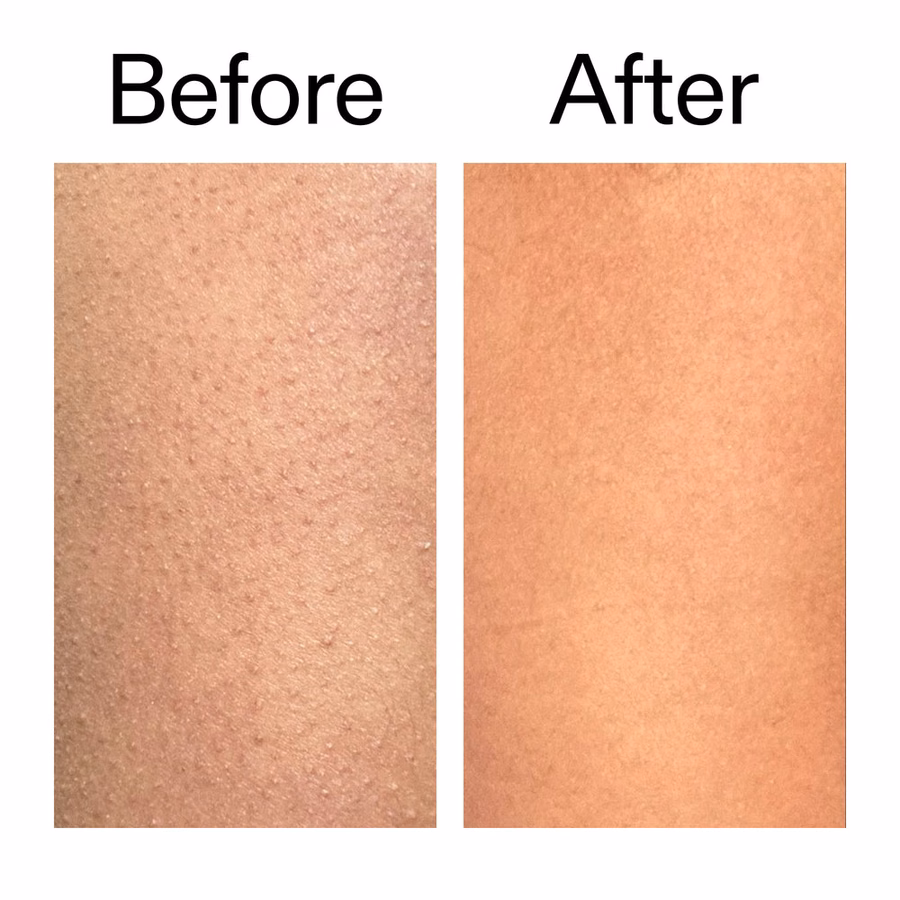 KP Treatment: Glycolic Acid Body Stick for Bumps & Ingrown Hairs | The INKEY List USA
