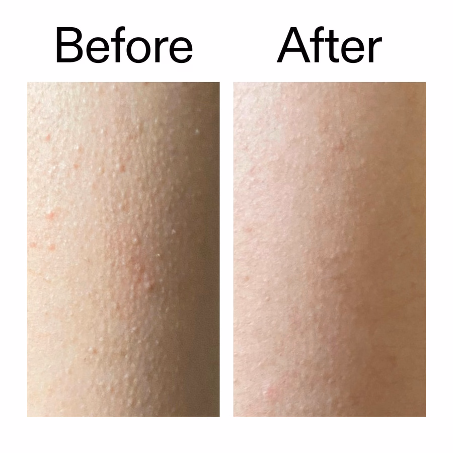 KP Treatment: Glycolic Acid Body Stick for Bumps & Ingrown Hairs | The INKEY List USA