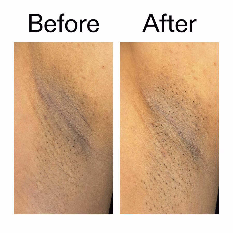 KP Treatment: Glycolic Acid Body Stick for Bumps & Ingrown Hairs | The INKEY List USA