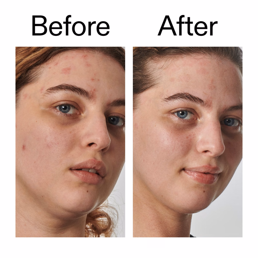 10% Urea Moisturizer | Urea Cream for Dry & Rough Skin | INKEY USA