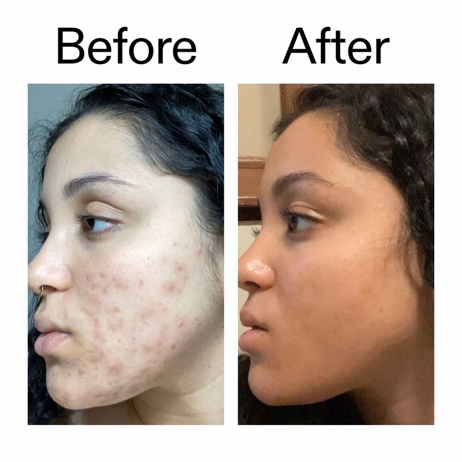 Dark Spot Serum with 2% Tranexamic Acid | Brightening Treatment | INKEY USA