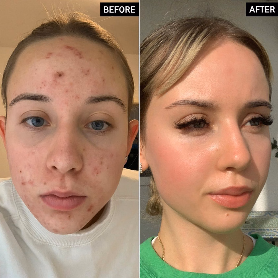 Dark Spot Serum with 2% Tranexamic Acid | Brightening Treatment | INKEY USA