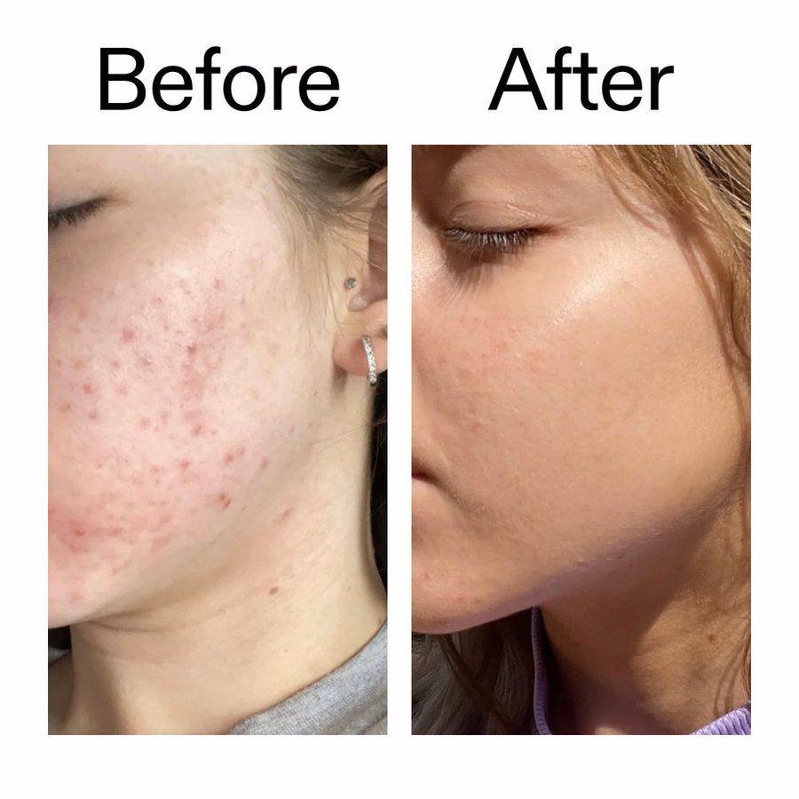10% Niacinamide Serum for Acne & Oil Control | The INKEY List
