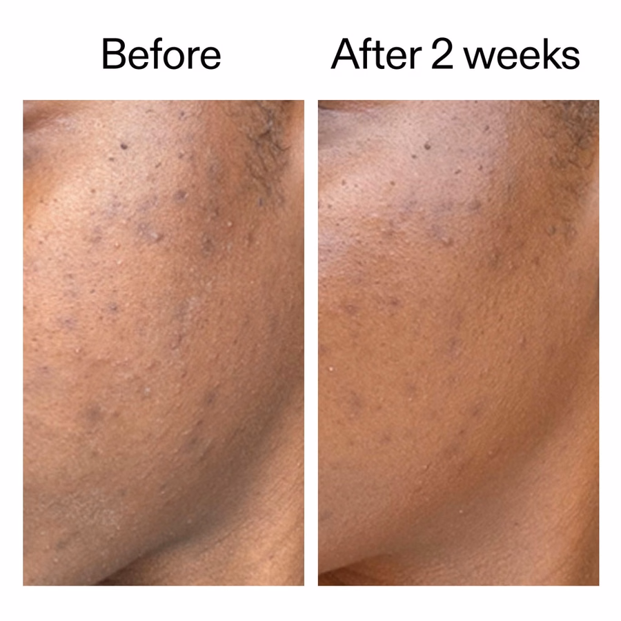Salicylic Acid Acne Serum with Dioic Acid | 360° Skin Clearing | INKEY USA